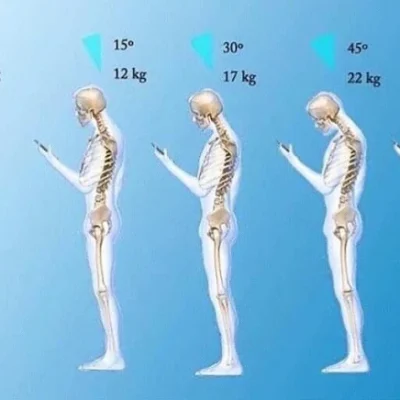 Diagram showing five skeletons using a mobile phone, each with increasing neck flexion angles (0°, 15°, 30°, 45°, 60°) and associated calculated head weights (4 kg to 27 kg) on a blue gradient background.